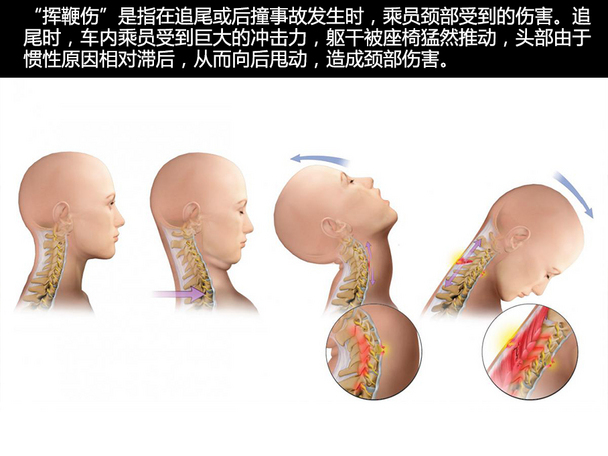 汽车头枕;头枕;安全;座椅;汽车座椅;汽车;颈枕;追尾;颈