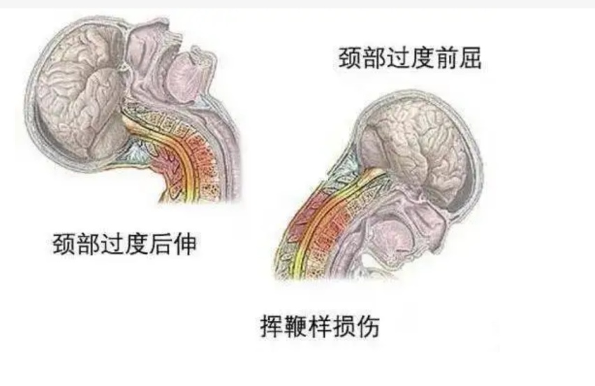 为什么汽车头枕都很不舒服，难道太舒服会影响生命安全？