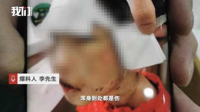 4岁女童遭生父继母虐打进ICU！警方最新通报：两人已被刑拘！