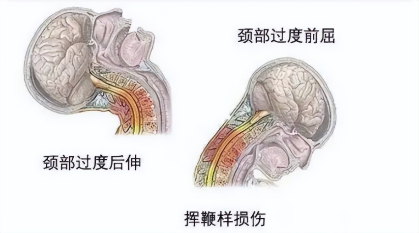 汽车头枕设计得那么反人类，99%的人都吐槽不舒适，为什么不改？